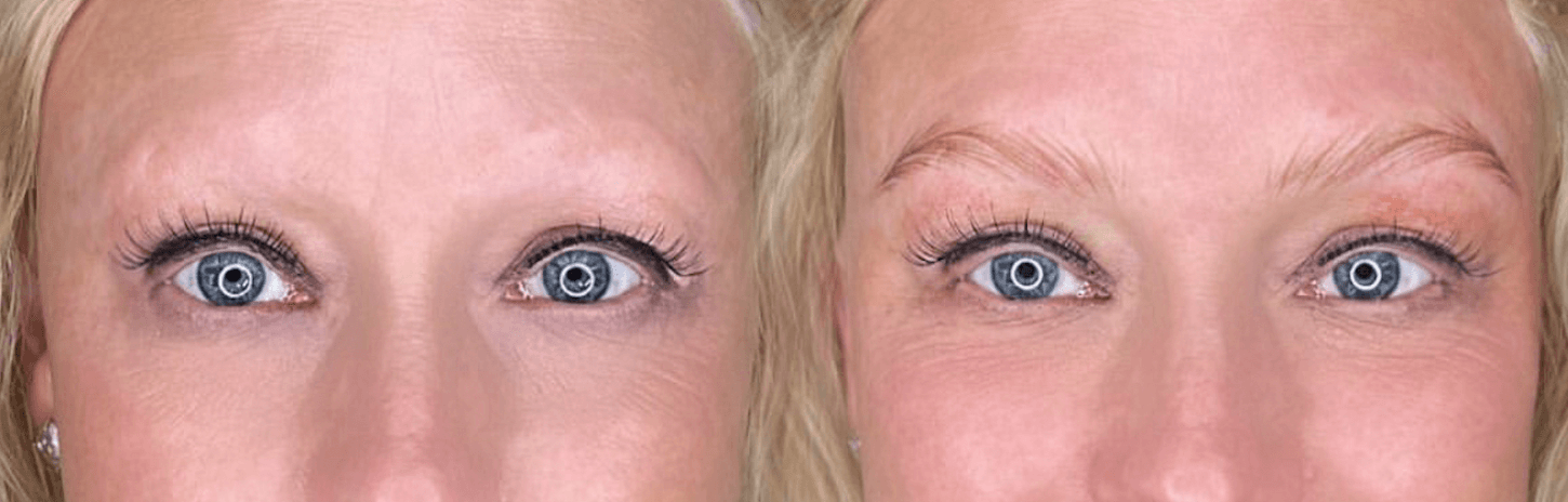 Removing Tattooed Eyeliner and Eyeliner Migration