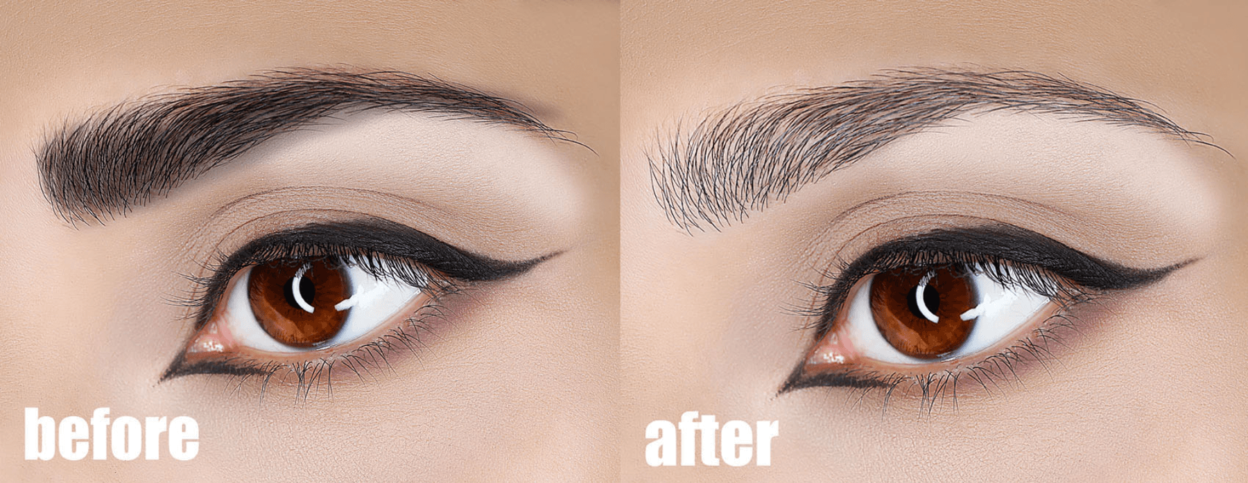 Saline Tattoo Removal