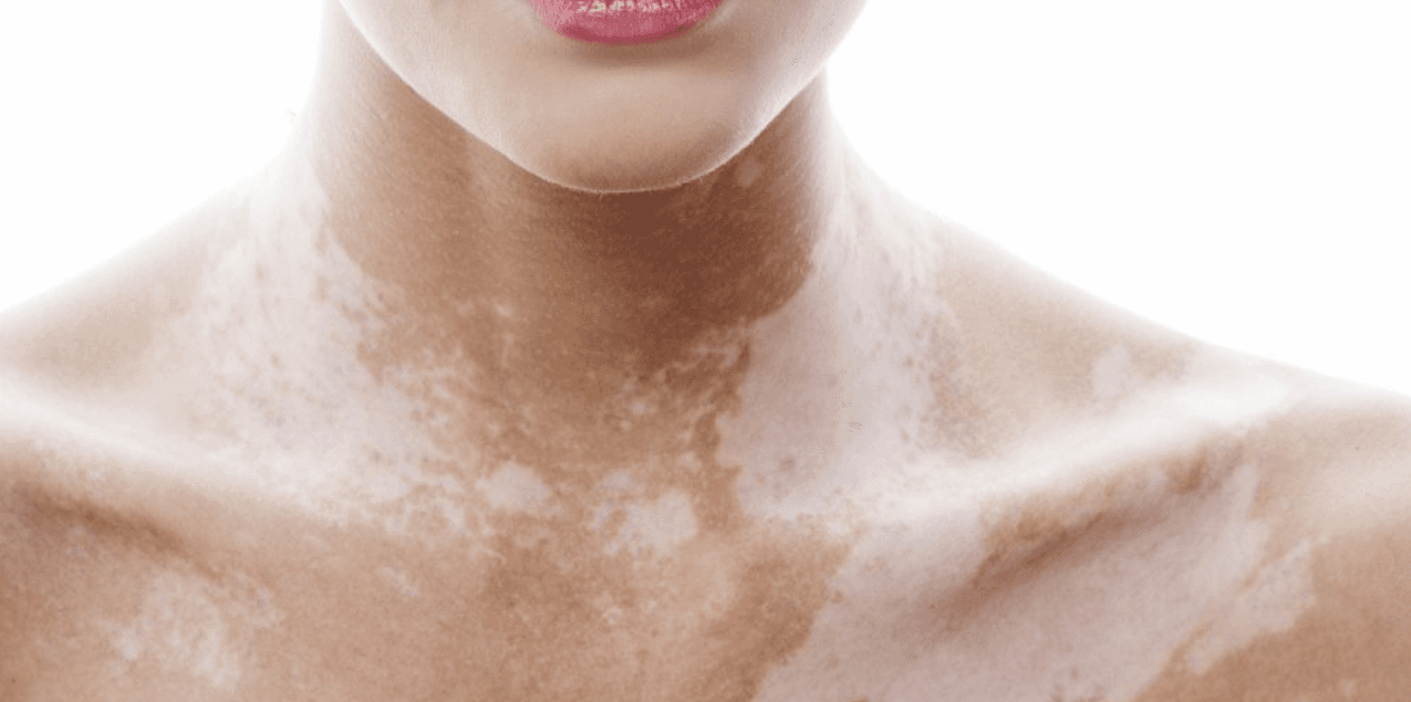 Vitiligo Camouflage