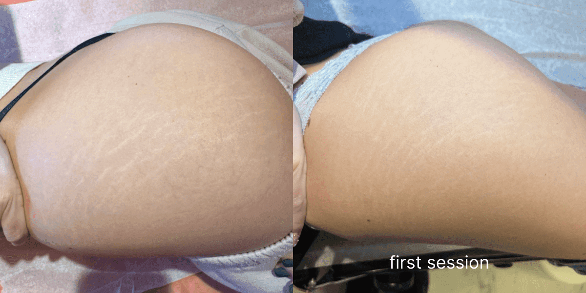 Stretch Marks Camouflage and Inkless Method