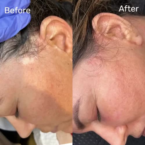 Professional Scar Camouflage Services in San Diego