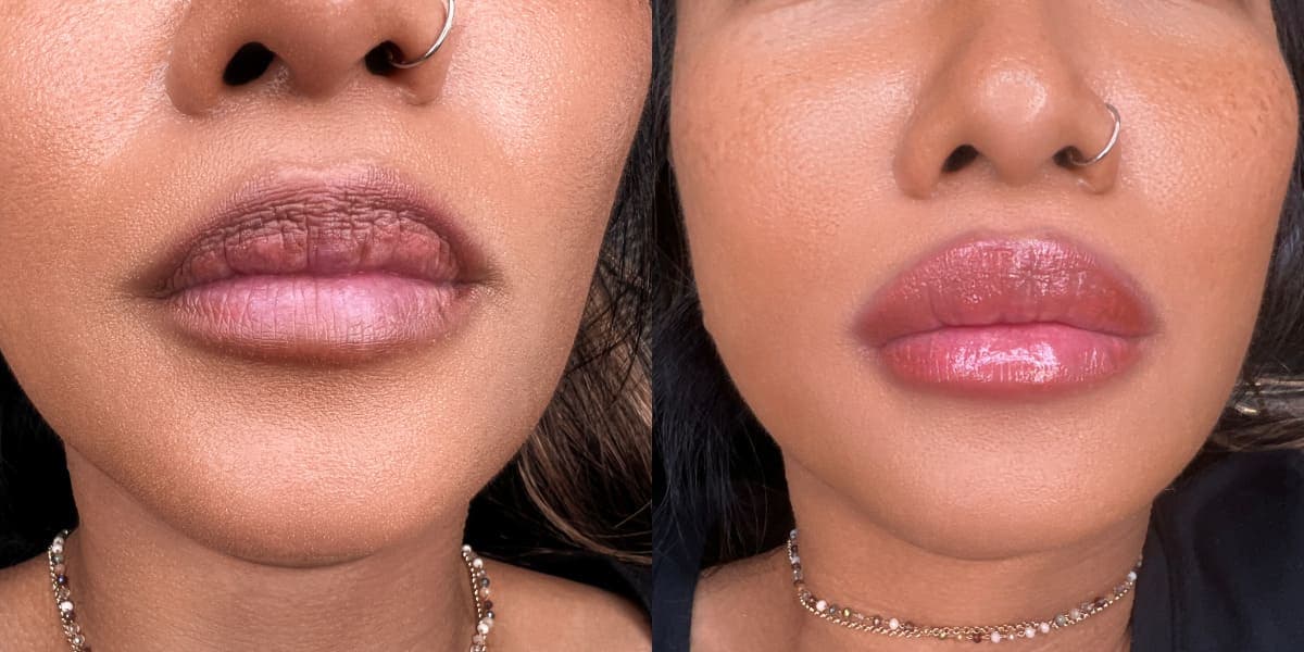 Lip Neutralization