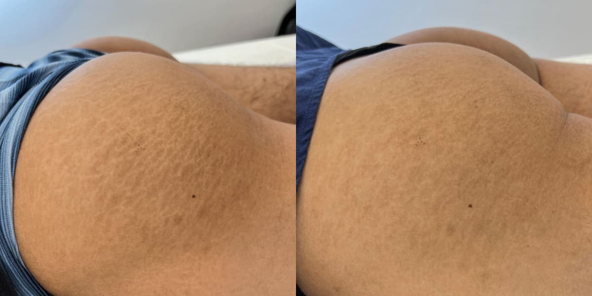 Stretch Mark Removal (Rejuvenation)  in San Diego