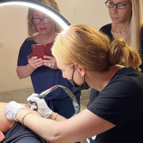 stretch mark rejuvenation in san diego