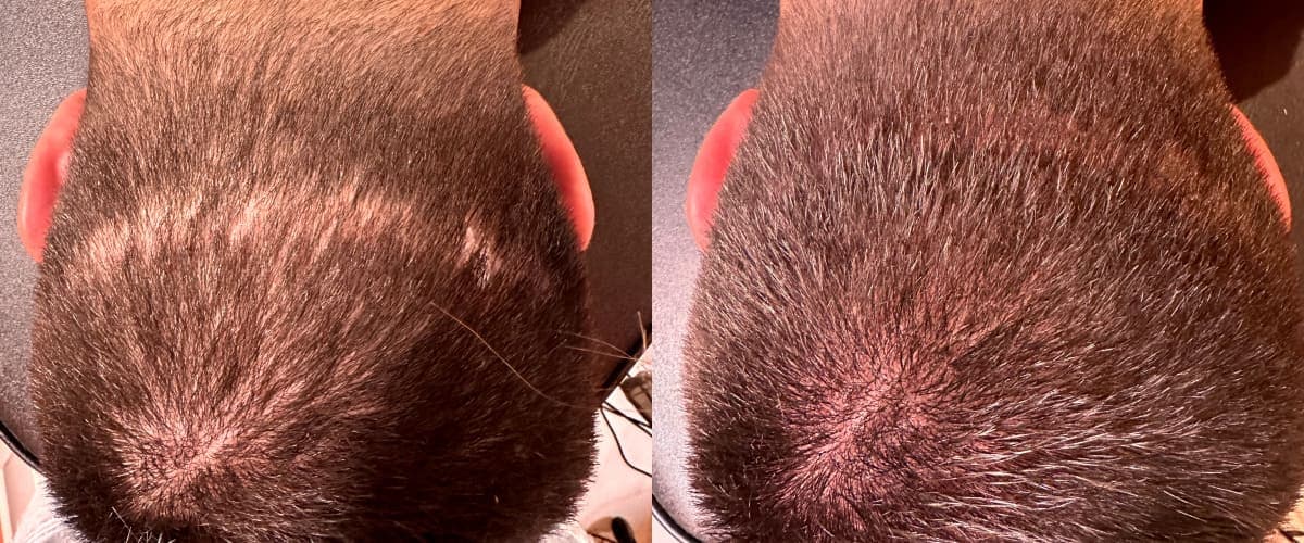 Scalp Micropigmentation San Diego