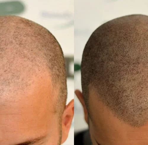 Scalp Micropigmentation San Diego