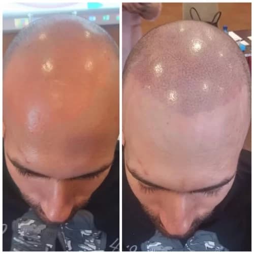 Scalp Micropigmentation San Diego