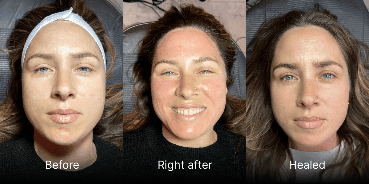 Microneedling San Diego