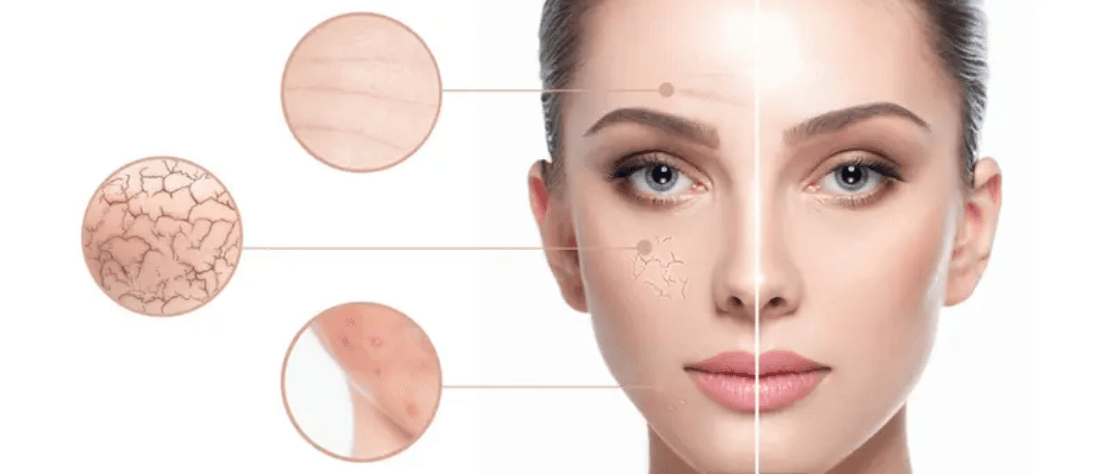 Chemical Peels for Hyperpigmentation – Detailed Guide