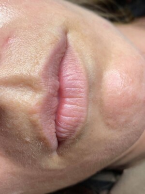 Before permanent makeup lips 1, Anna Kara PMU