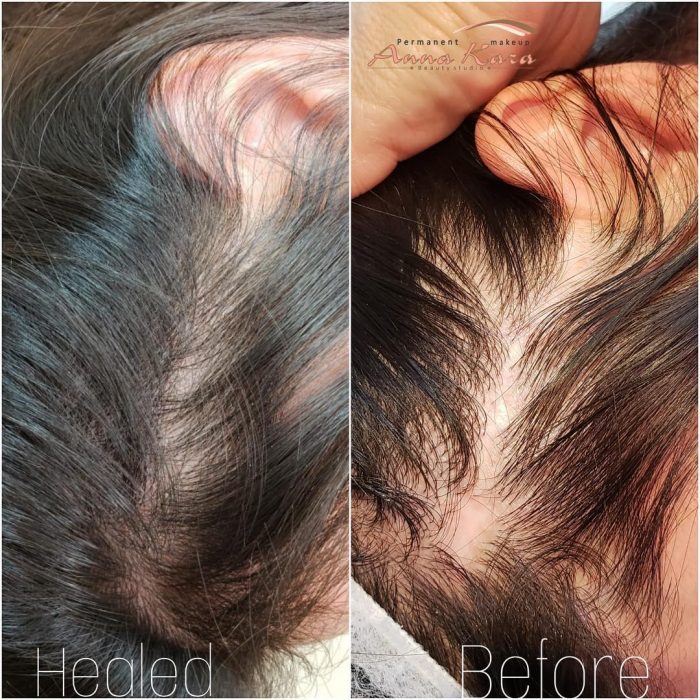 Hair loss. Amazing results of scalp micropigmentation