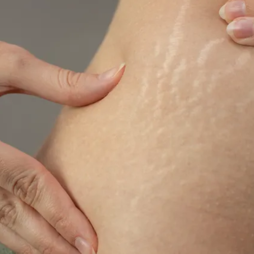 Inkless Stretch Mark Revision