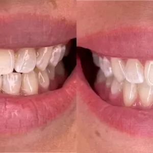 Teeth Whitening