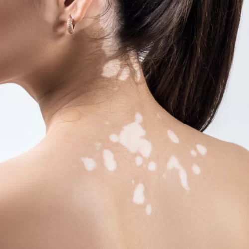 Advantages of the Vitiligo Camouflaging procedure