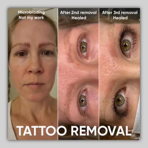 Saline Tattoo Removal