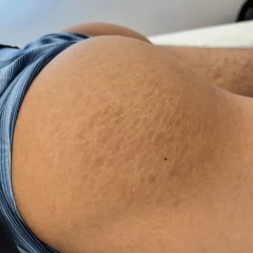 stretch mark rejuvenation in san diego 2