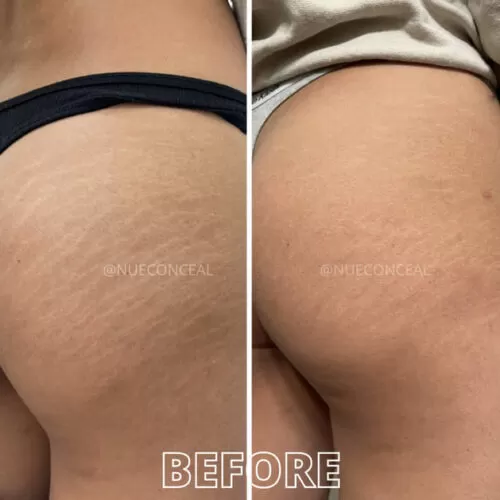 stretch mark rejuvenation in san diego 4