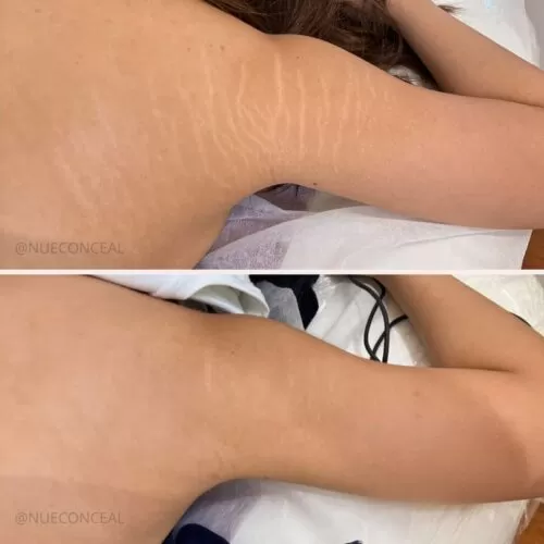 stretch mark rejuvenation in san diego 5