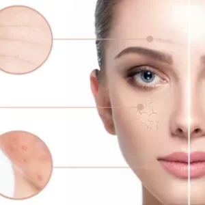 Chemical Peels for Hyperpigmentation - Detailed Guide